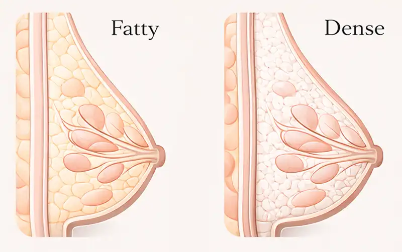 Illustration comparing fatty and dense breast tissue to explain the need for advanced breast imaging like ABUS